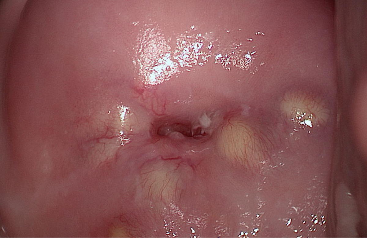 Cervix Colposcopy